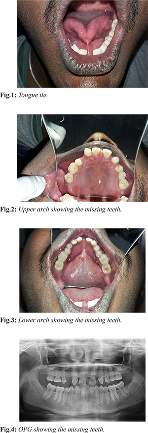 Partial Anodontia With Ankyloglossia